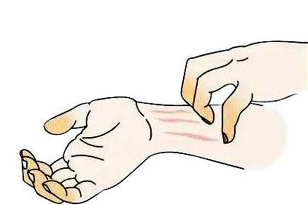 冬季濕疹怎么辦 預防才是重點 冬季濕疹怎么辦 預防才是重點