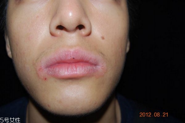 唇炎是怎么引起的 唇炎怎么治療好的快 唇炎是怎么引起的 唇炎怎么治療好的快