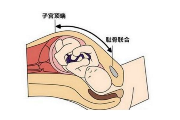 孕婦測量宮高有什么作用 孕婦測量宮高有什么作用