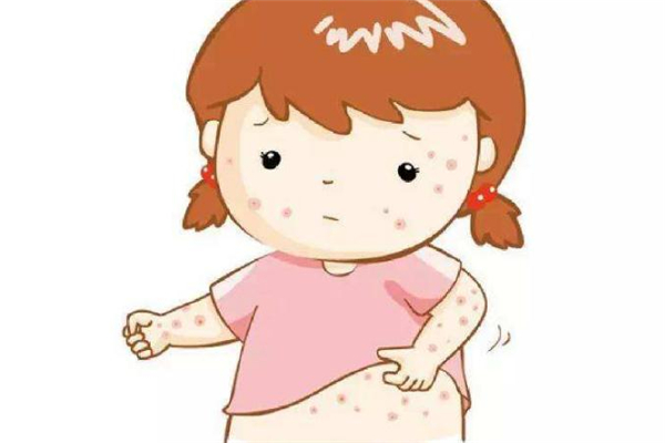 缺脂性皮炎癥狀與保養(yǎng)治療 缺脂性皮炎癥狀與保養(yǎng)治療