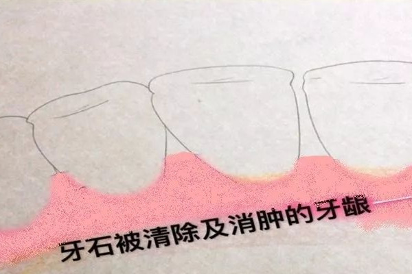 為什么洗牙有異物感 洗牙的誤區(qū) 為什么洗牙有異物感 洗牙的誤區(qū)