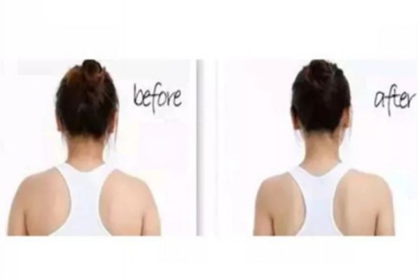 瘦肩針前后對比照片 瘦肩針注射一定要選擇正規(guī)醫(yī)美 瘦肩針前后對比照片 瘦肩針注射一定要選擇正規(guī)醫(yī)美