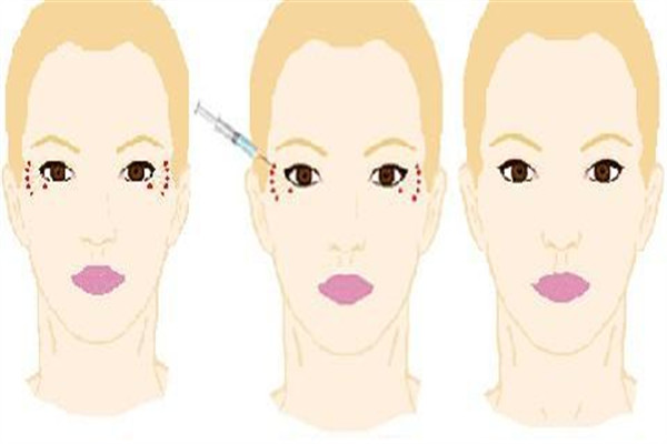 注射除皺針會老的更快嗎 除皺針好壞處 注射除皺針會老的更快嗎 除皺針好壞處