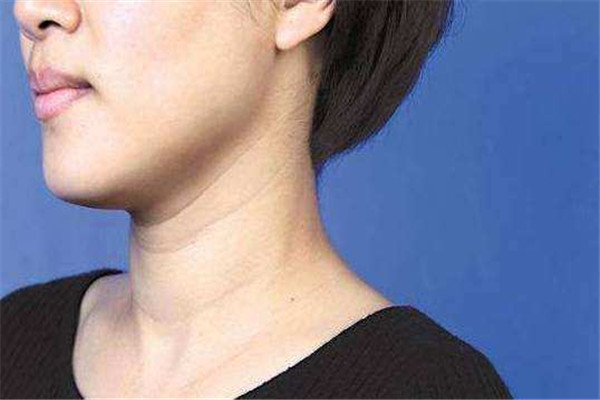 頸紋如何消除 頸紋這樣消除 頸紋如何消除 頸紋這樣消除