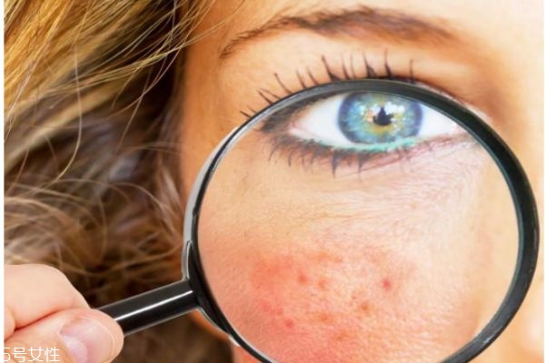 臉上經常去角質好嗎 去角質必知小常識