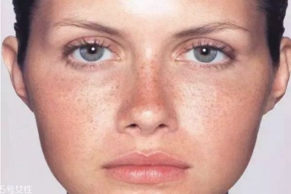 色斑的形成原因和去除方法 斑的五大成因 色斑的形成原因和去除方法 斑的五大成因