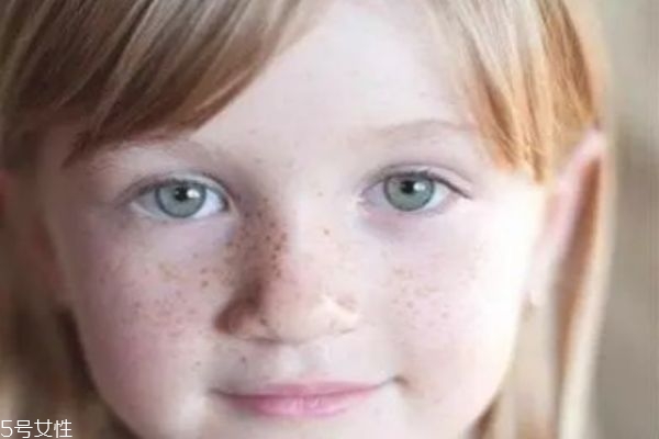色斑的形成原因和去除方法 斑的五大成因 色斑的形成原因和去除方法 斑的五大成因