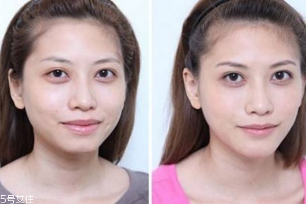 墊下巴前后對(duì)比照片 墊下巴的優(yōu)缺點(diǎn)