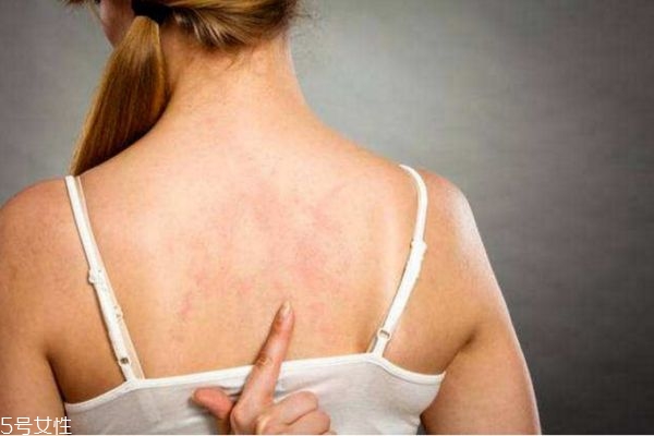 背上長(zhǎng)痘痘怎么消除 背上長(zhǎng)痘痘的原因和解決方法 背上長(zhǎng)痘痘怎么消除 背上長(zhǎng)痘痘的原因和解決方法