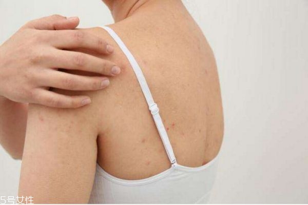 背上長(zhǎng)痘痘怎么消除 背上長(zhǎng)痘痘的原因和解決方法 背上長(zhǎng)痘痘怎么消除 背上長(zhǎng)痘痘的原因和解決方法