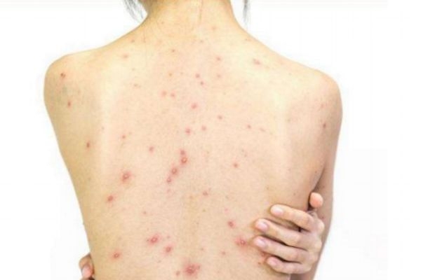 背上長(zhǎng)痘痘怎么消除 背上長(zhǎng)痘痘的原因和解決方法 背上長(zhǎng)痘痘怎么消除 背上長(zhǎng)痘痘的原因和解決方法