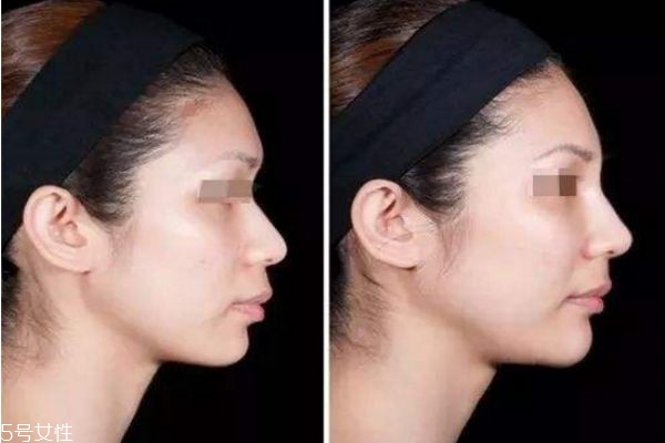 達(dá)拉斯隆鼻和普通隆鼻有什么區(qū)別 達(dá)拉斯隆鼻前后圖 達(dá)拉斯隆鼻和普通隆鼻有什么區(qū)別 達(dá)拉斯隆鼻前后圖