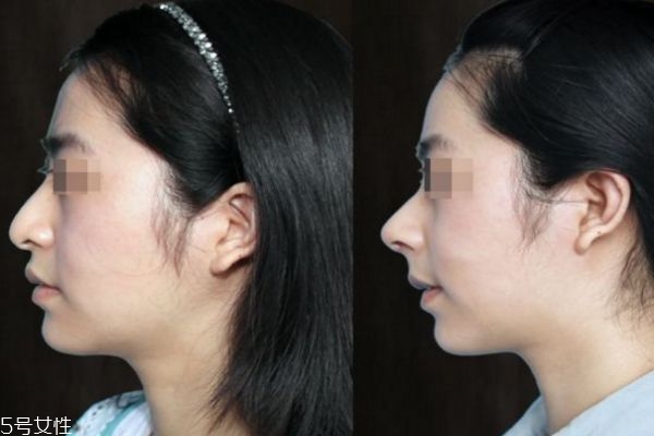 達(dá)拉斯隆鼻和普通隆鼻有什么區(qū)別 達(dá)拉斯隆鼻前后圖 達(dá)拉斯隆鼻和普通隆鼻有什么區(qū)別 達(dá)拉斯隆鼻前后圖
