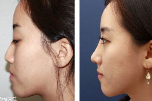 達(dá)拉斯隆鼻和普通隆鼻有什么區(qū)別 達(dá)拉斯隆鼻前后圖 達(dá)拉斯隆鼻和普通隆鼻有什么區(qū)別 達(dá)拉斯隆鼻前后圖