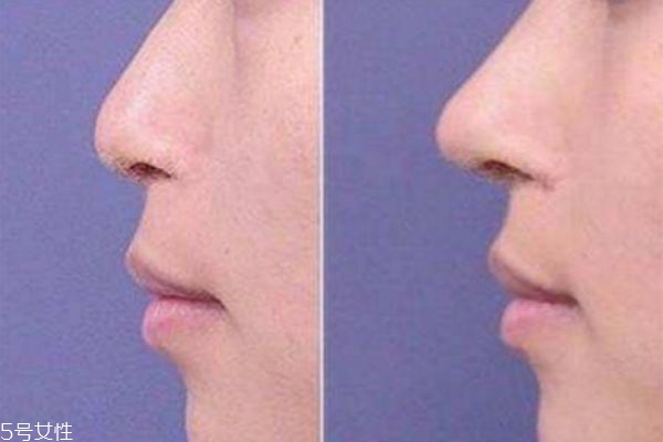 達(dá)拉斯隆鼻和普通隆鼻有什么區(qū)別 達(dá)拉斯隆鼻前后圖 達(dá)拉斯隆鼻和普通隆鼻有什么區(qū)別 達(dá)拉斯隆鼻前后圖