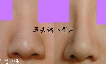 鼻頭縮小術(shù)有風(fēng)險(xiǎn)嗎 鼻頭縮小術(shù)有風(fēng)險(xiǎn)嗎