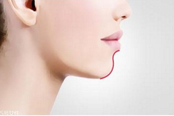 墊下巴多久可以恢復(fù) 墊下巴要恢復(fù)多久 墊下巴多久可以恢復(fù) 墊下巴要恢復(fù)多久