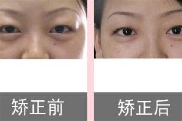 眼皮抽脂效果好嗎 眼皮抽脂前后效果對(duì)比 眼皮抽脂效果好嗎 眼皮抽脂前后效果對(duì)比