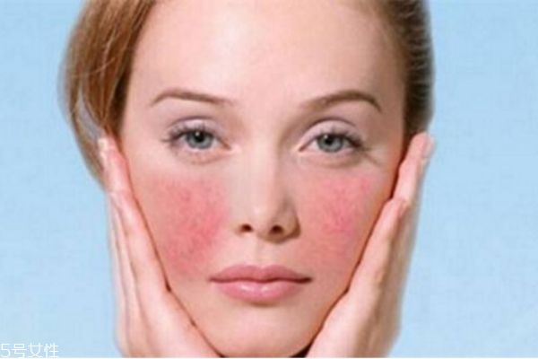 洋甘菊去紅血絲嗎 紅血絲去除方法 洋甘菊去紅血絲嗎 紅血絲去除方法