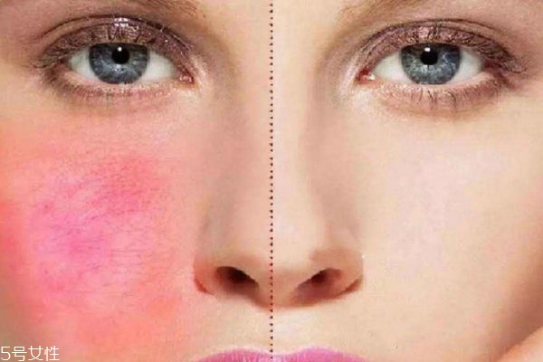 洋甘菊去紅血絲嗎 紅血絲去除方法 洋甘菊去紅血絲嗎 紅血絲去除方法