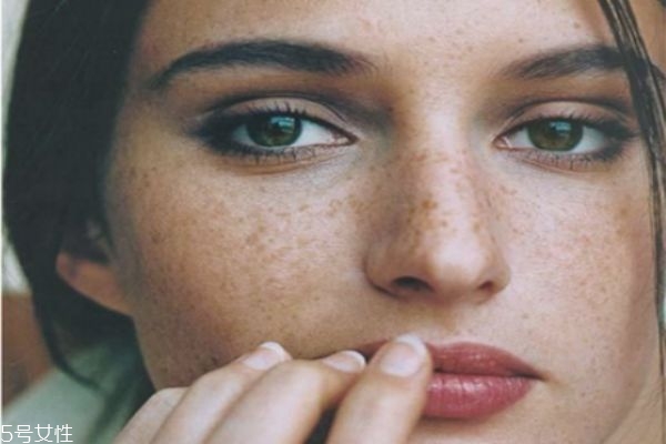 臉上有好多斑怎樣祛斑 激光祛斑才夠徹底 臉上有好多斑怎樣祛斑 激光祛斑才夠徹底