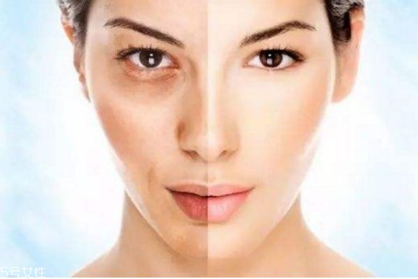 果酸換膚的原理 果酸換膚的優(yōu)缺點 果酸換膚的原理 果酸換膚的優(yōu)缺點