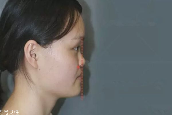 做鼻基底填充能改善法令紋嗎 有一定改善 做鼻基底填充能改善法令紋嗎 有一定改善