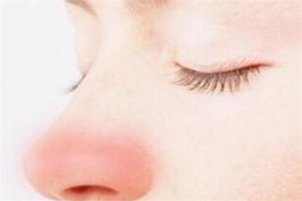 酒糟鼻是什么樣子 酒糟鼻治療方法 酒糟鼻是什么樣子 酒糟鼻治療方法