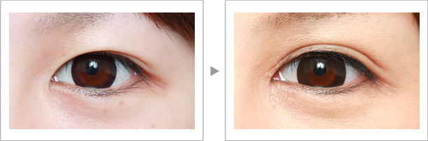 如何按摩眼睛變大 眼頭切開風(fēng)按摩 如何按摩眼睛變大 眼頭切開風(fēng)按摩