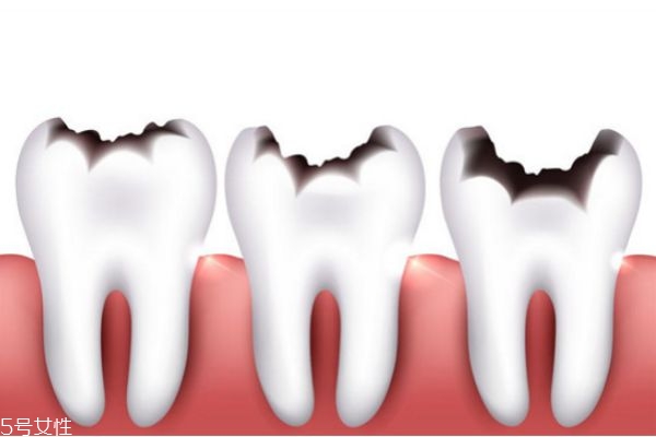 牙結(jié)石清理多少錢(qián) 去除牙結(jié)石價(jià)格