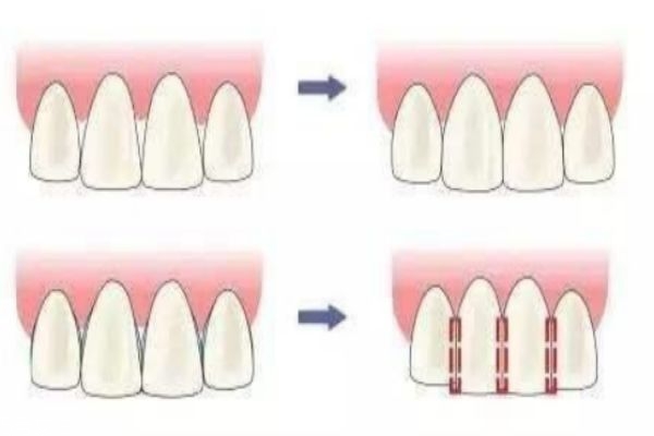 如何修正牙齒 牙齒不好看怎么辦 如何修正牙齒 牙齒不好看怎么辦
