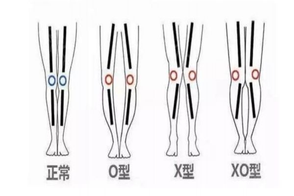腿型不好看怎么辦 如何修正O型腿 腿型不好看怎么辦 如何修正O型腿