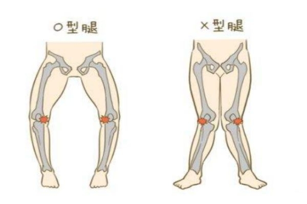 腿型不好看怎么辦 如何修正O型腿 腿型不好看怎么辦 如何修正O型腿