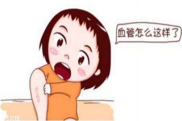 什么是經(jīng)脈曲張 將脈曲張的危害是什么 什么是經(jīng)脈曲張 將脈曲張的危害是什么