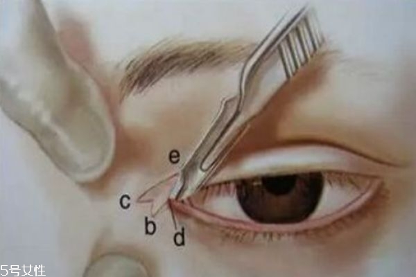開眼角的好處是什么呢 開眼角需要注意什么呢 開眼角的好處是什么呢 開眼角需要注意什么呢