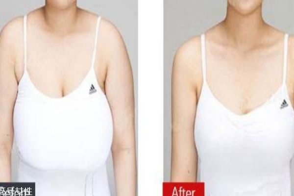 縮胸手術(shù)是什么 為什么要做縮胸手術(shù) 縮胸手術(shù)是什么 為什么要做縮胸手術(shù)