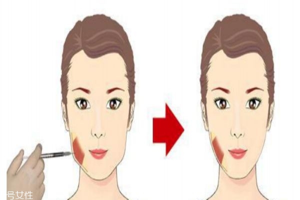 瘦臉針有副作用嗎 瘦臉針的價格是多少 瘦臉針有副作用嗎 瘦臉針的價格是多少
