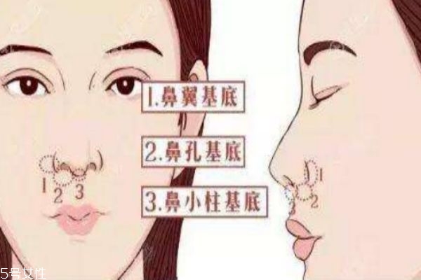 鼻基底填充有無副作用呢 鼻基底填充的價(jià)格有什么呢 鼻基底填充有無副作用呢 鼻基底填充的價(jià)格有什么呢