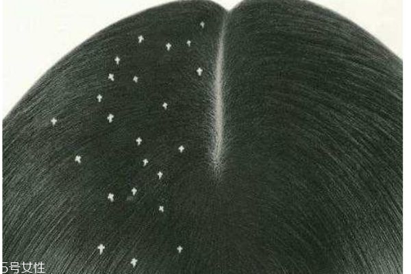 什么是頭皮屑 為什么人會有頭皮屑 什么是頭皮屑 為什么人會有頭皮屑