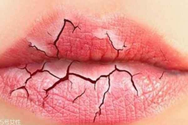 夏天為什么容易嘴巴起皮呢 如何治療嘴巴起皮呢 夏天為什么容易嘴巴起皮呢 如何治療嘴巴起皮呢