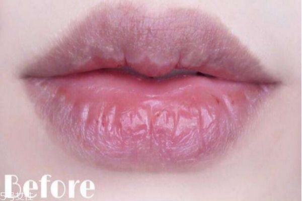 為什么唇色深 天生唇色深是什么原因 為什么唇色深 天生唇色深是什么原因