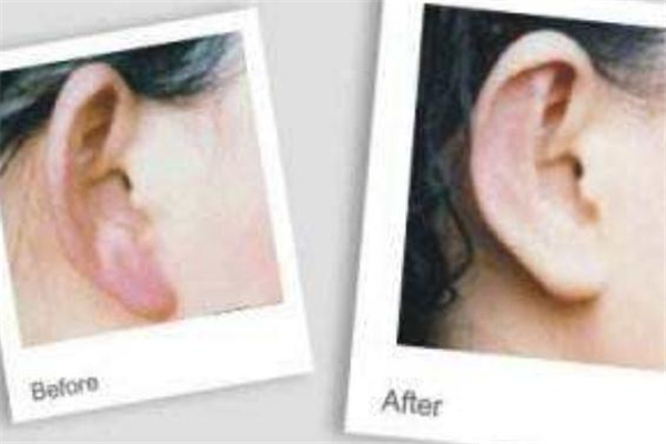 玻尿酸豐耳垂效果好嗎 玻尿酸豐耳垂前后對(duì)比 玻尿酸豐耳垂效果好嗎 玻尿酸豐耳垂前后對(duì)比