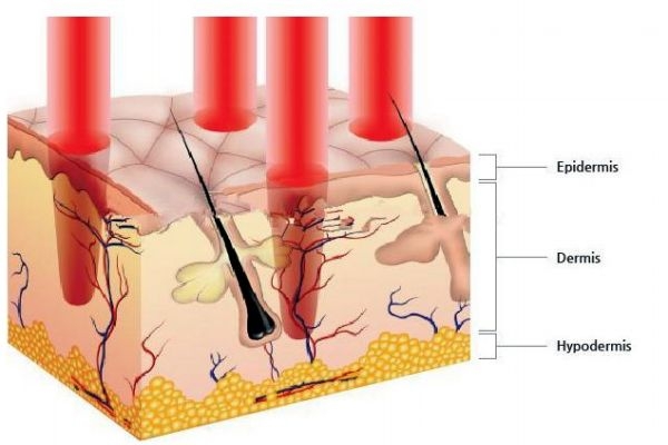 點陣激光有什么用呢 點陣激光有什么危害嗎 點陣激光有什么用呢 點陣激光有什么危害嗎