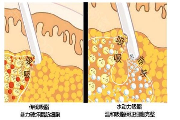 什么是水動(dòng)力吸脂呢 水動(dòng)力吸脂有什么用呢 什么是水動(dòng)力吸脂呢 水動(dòng)力吸脂有什么用呢