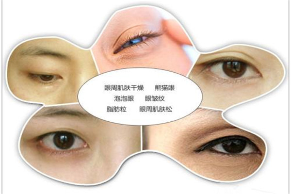 黑眼圈用土豆片可以去除嗎 黑眼圈去除方法 黑眼圈用土豆片可以去除嗎 黑眼圈去除方法