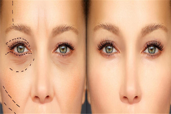 黑眼圈按摩儀有用嗎 黑眼圈要給眼睛適當(dāng)?shù)男菹r(shí)間 黑眼圈按摩儀有用嗎 黑眼圈要給眼睛適當(dāng)?shù)男菹r(shí)間