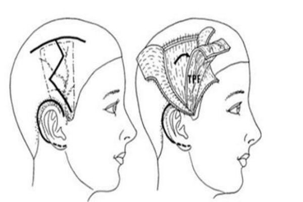 豐耳垂有什么注意事項(xiàng)嗎 破尿酸豐耳垂有什么好處呢 豐耳垂有什么注意事項(xiàng)嗎 破尿酸豐耳垂有什么好處呢