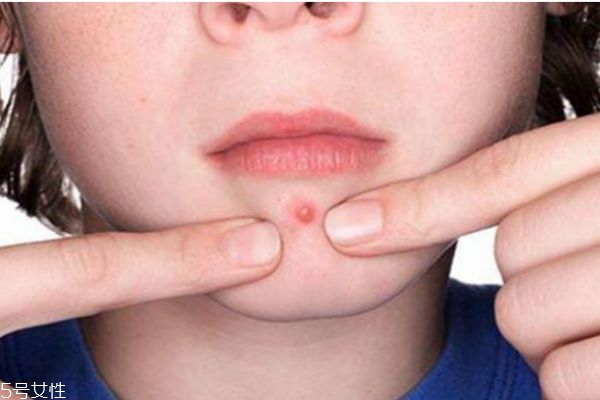 下巴長痘痘怎么辦 下巴長痘痘這樣調理