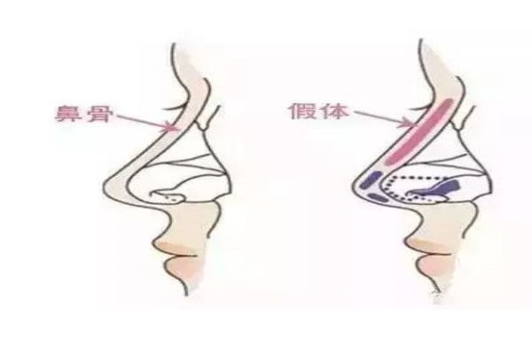 什么是膨體隆鼻呢 膨體隆鼻的原理是什么呢 什么是膨體隆鼻呢 膨體隆鼻的原理是什么呢