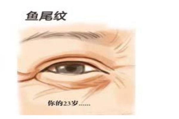 為什么會長魚尾紋呢 怎么樣可以消除魚尾紋呢 為什么會長魚尾紋呢 怎么樣可以消除魚尾紋呢